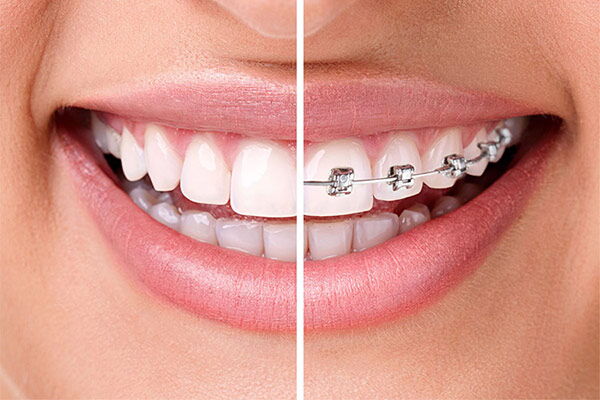 Invisalign System oder Zahnspange mit Brackets