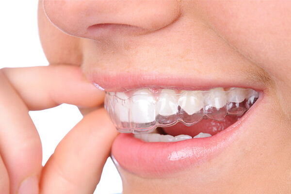 Zahnschienen Invisalign KFO Hasle Luzern