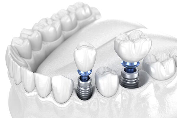 Implantate Zahn Hasle Luzern Biosphäre