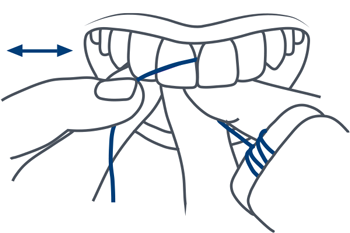 Anwendung Zahnseide Oberkiefer Zahnarzt LU Hasle