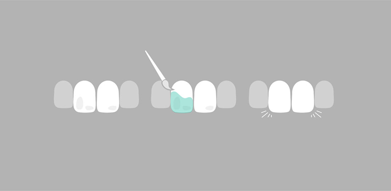 Icon-Behandlung Kariesinfiltration
