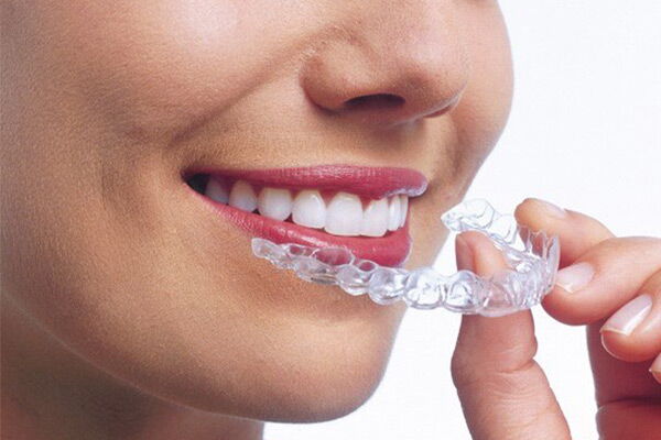Invisalign Zahnschienen KFO Dr. Dauter Hasle