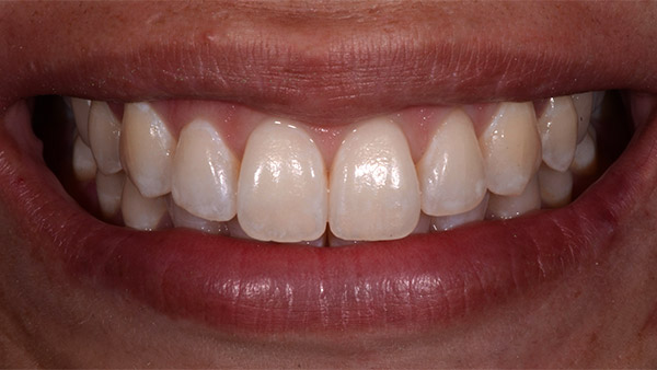 Frontzähne nach der Behandlung mit ICON